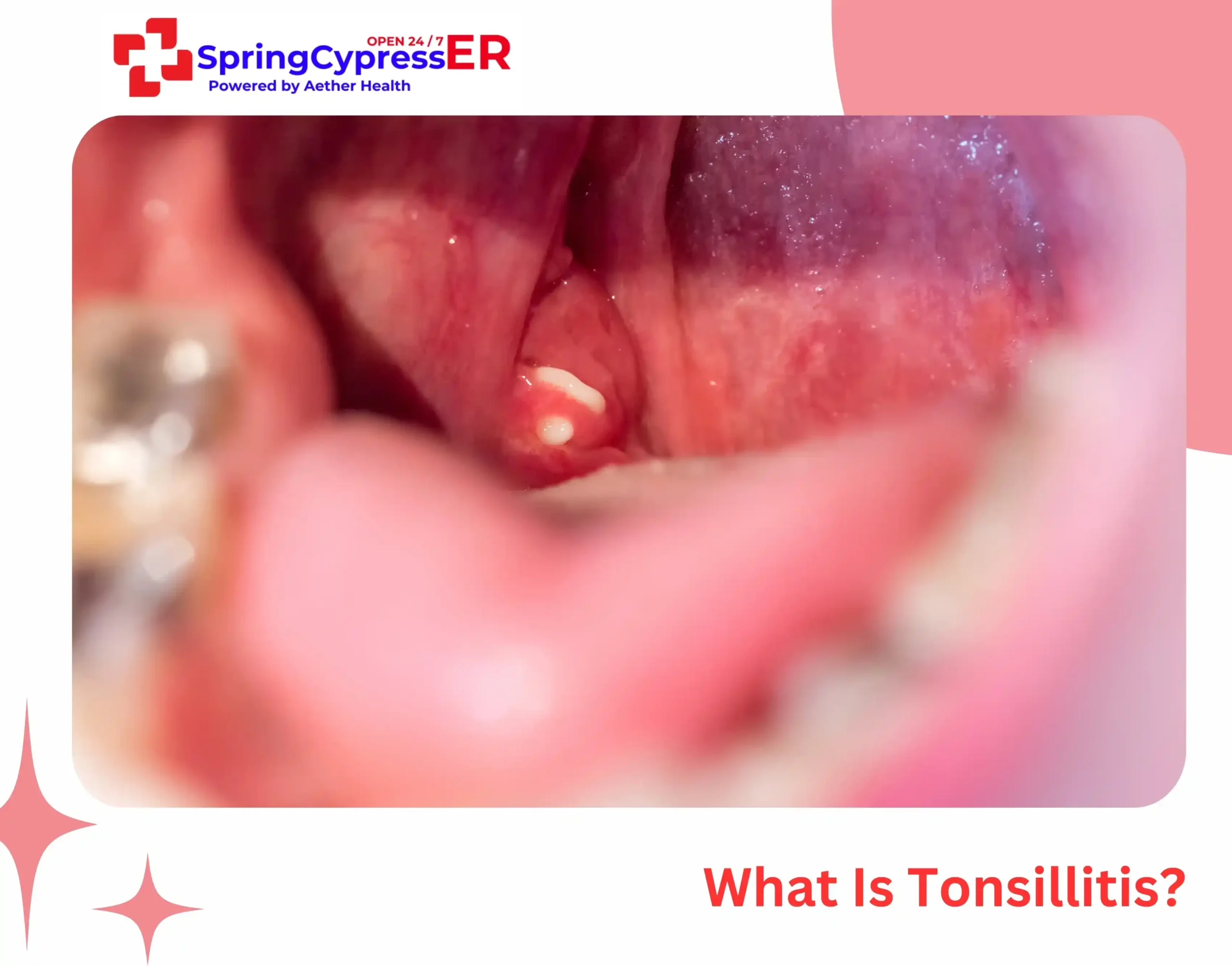 What Is Tonsillitis