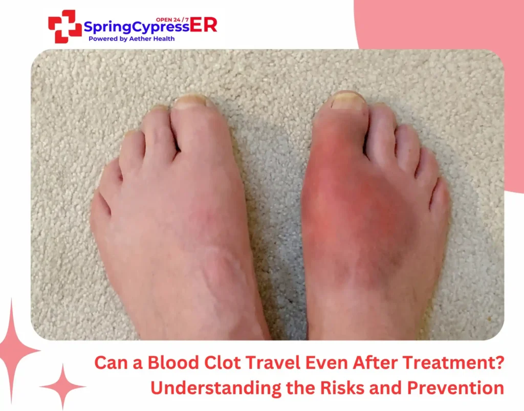 Can a Blood Clot Travel Even After Treatment Understanding the Risks and Prevention