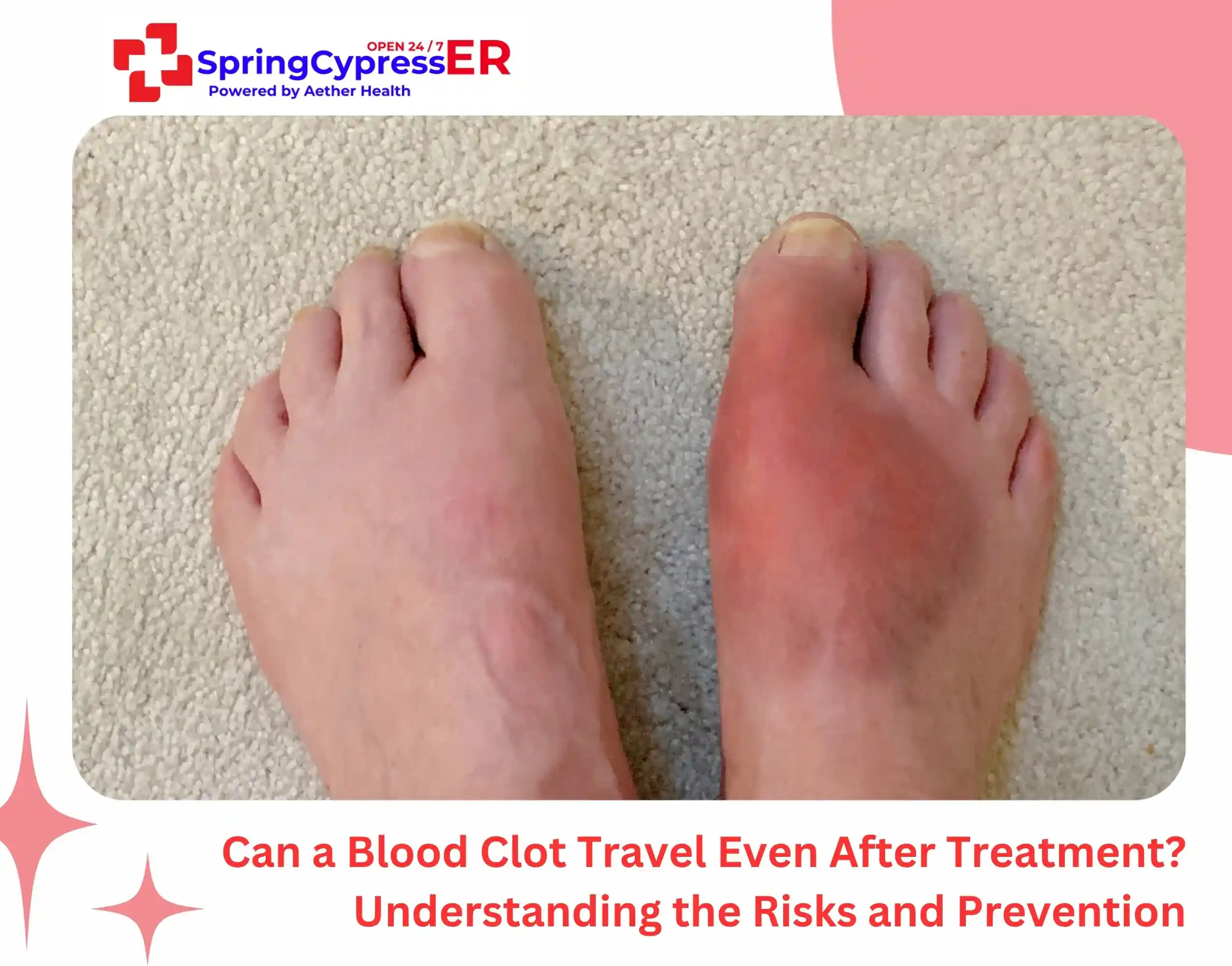 Can a Blood Clot Travel Even After Treatment Understanding the Risks and Prevention