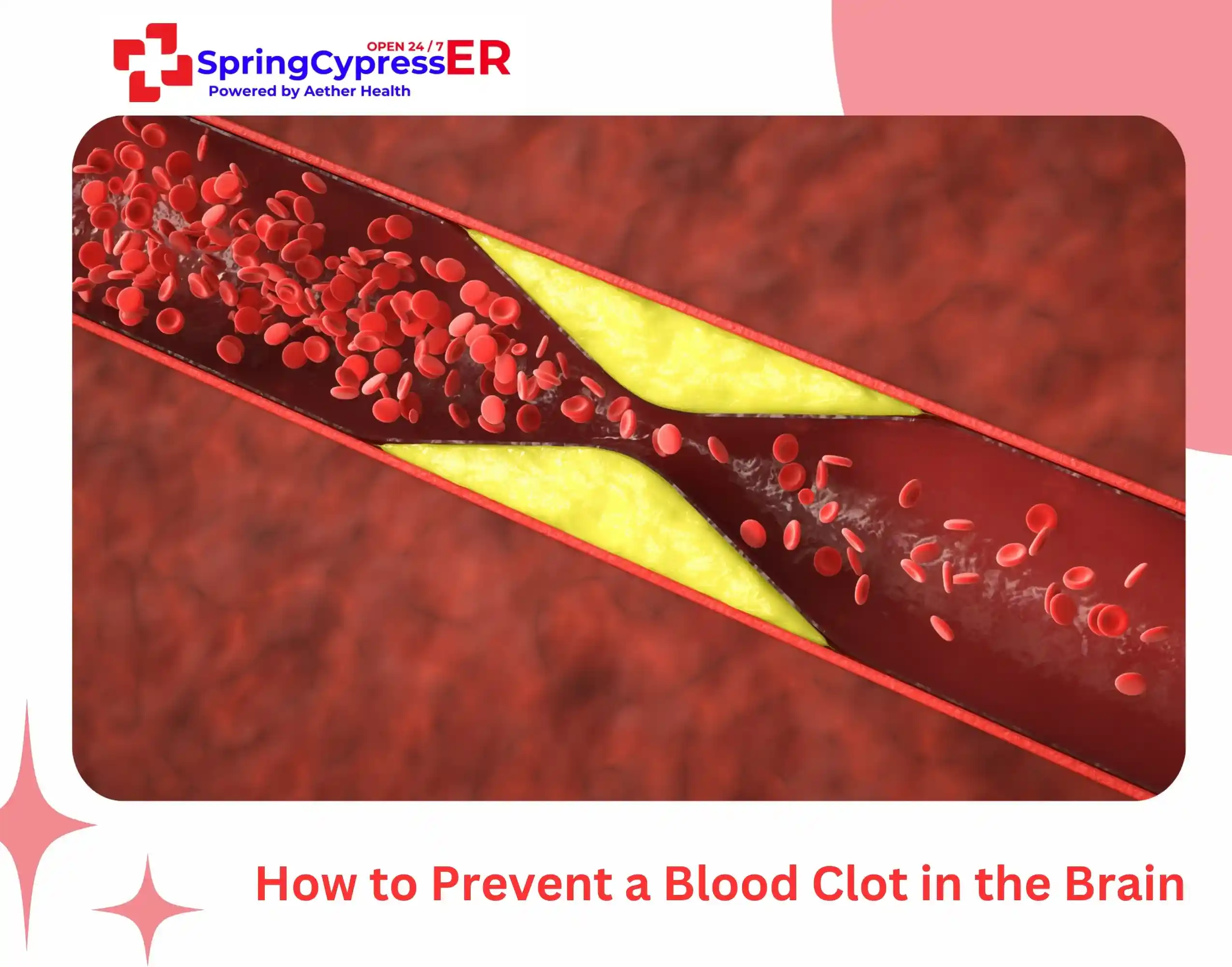 How to Prevent a Blood Clot in the Brain