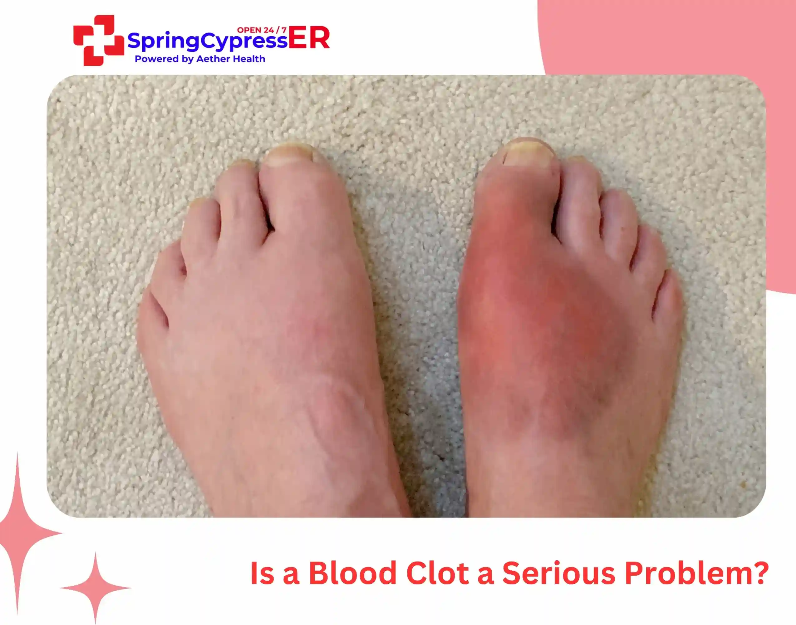 Is a Blood Clot a Serious Problem