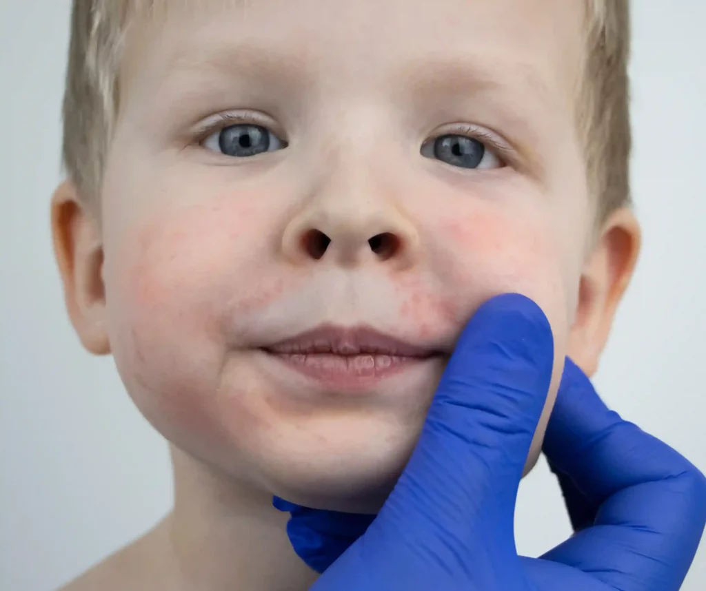Mild to Moderate Allergic Reactions, Rashes