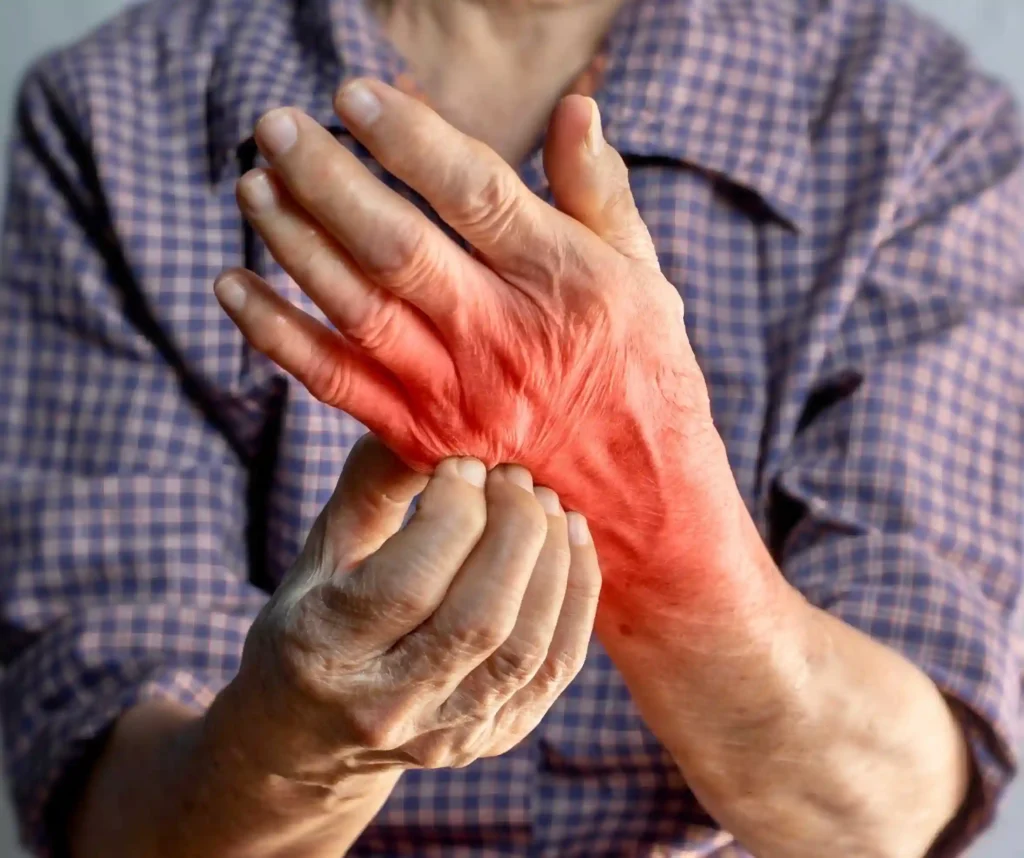 Severe Allergic Reactions (Anaphylaxis), Rashes