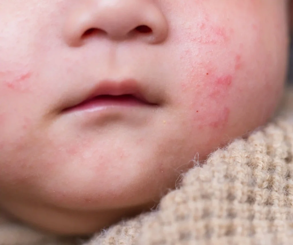 Emergency Care & Specialist Coordination, Rashes