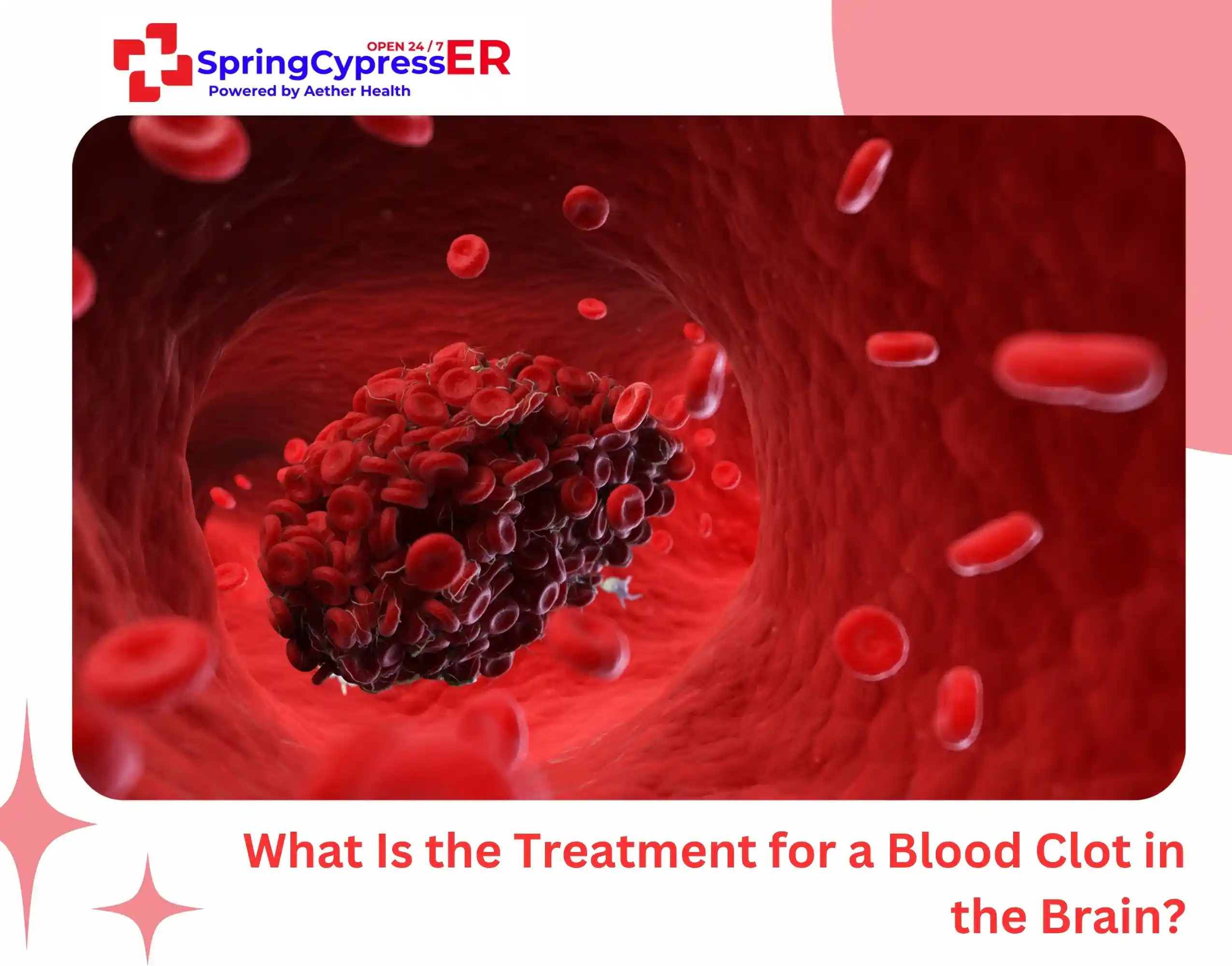 What Is the Treatment for a Blood Clot in the Brain
