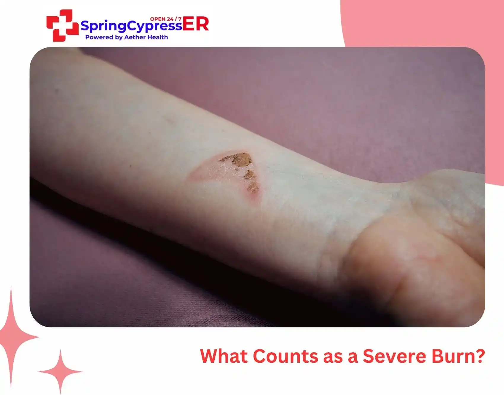 burn care journey stages