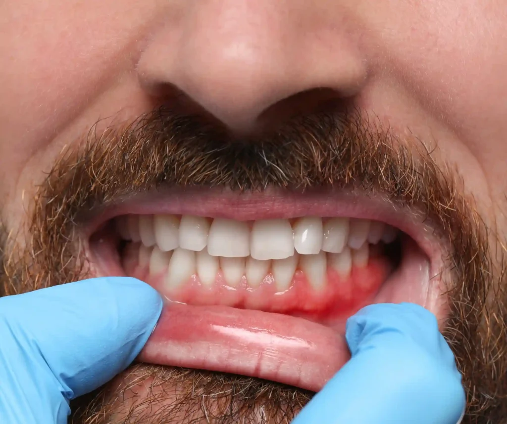 Abscess treatment
