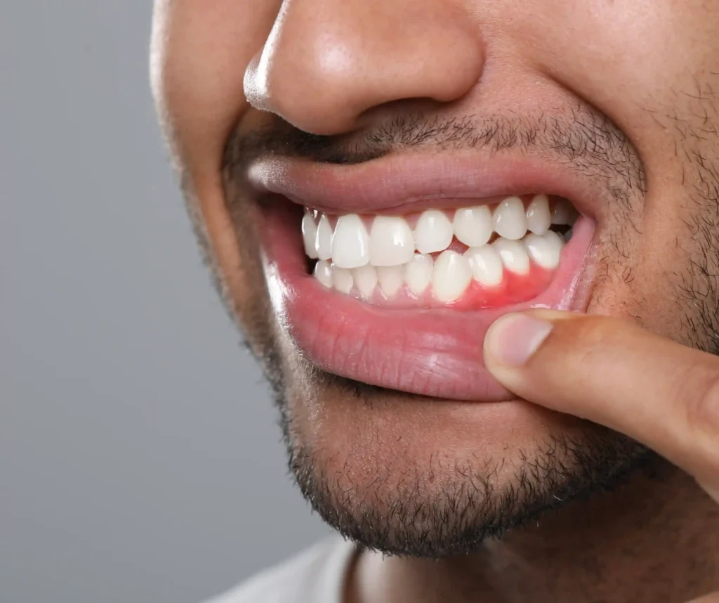 Abscess treatment