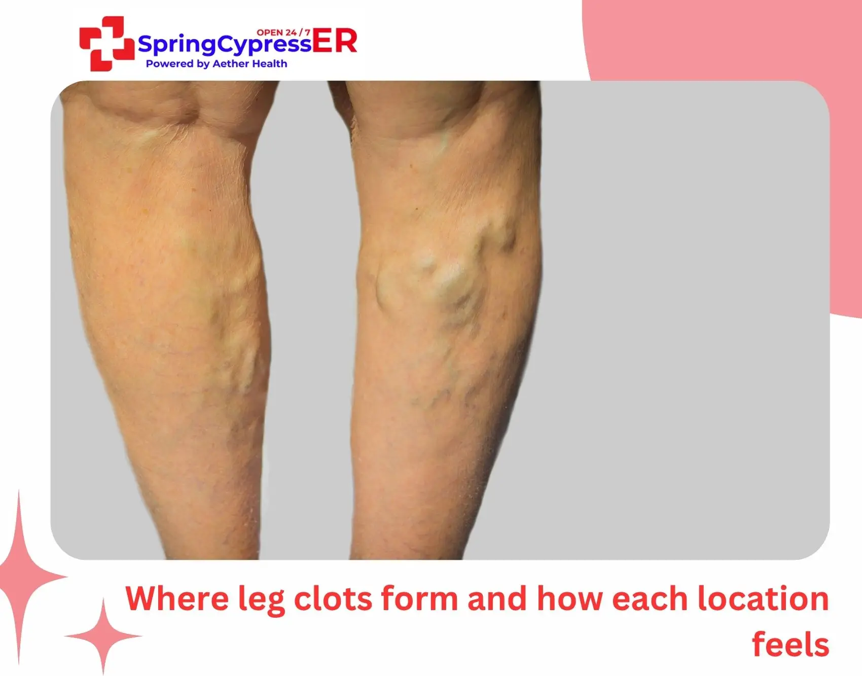 Where leg clots form and how each location feels